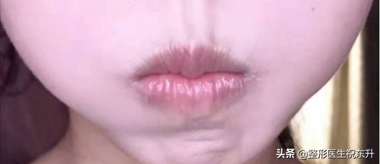 法令纹严重怎么办30岁,中年人怎么去除法令纹