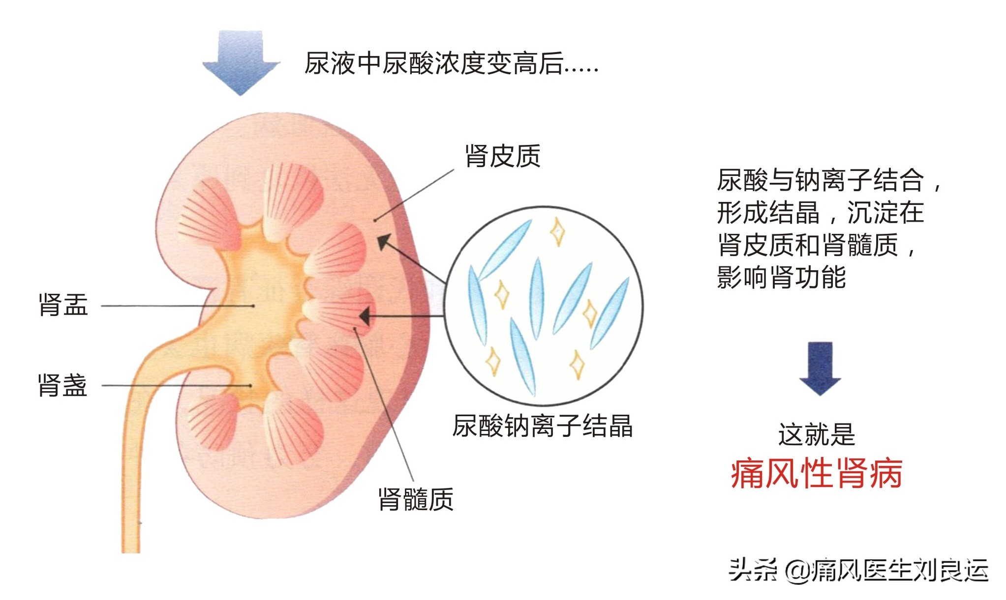 痛风引起的肌酐升高113可以恢复吗,肌酐尿酸偏高的原因和解决方法