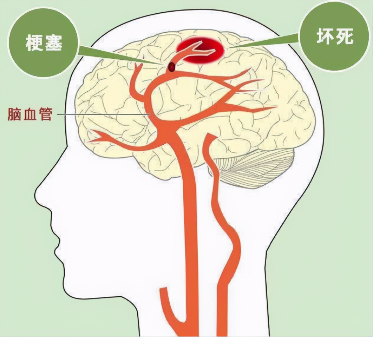 脑梗前兆一定牢记这几点能自救,脑梗康复十大注意事项