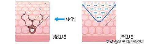 去斑点淡斑最有效方法,去斑点的最好方法最快最有效果