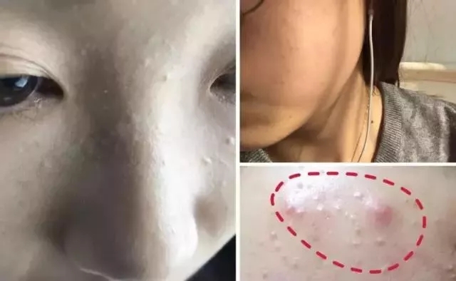 闭口粉刺去美容院清闭口好吗,如何正确去除粉刺闭口