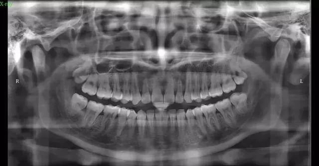 牙齿矫正全过程看完你就知道,目前几种常见的牙齿矫正方式