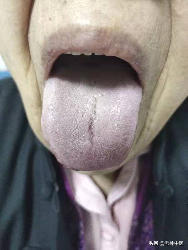 老年人止咳化痰有良方,治疗老人咳嗽肺炎的中药配方