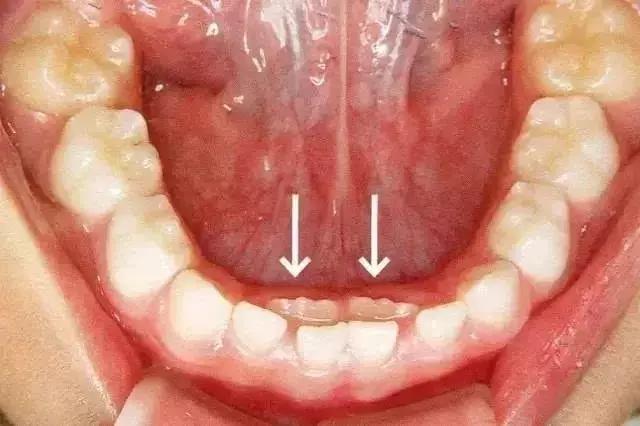 孩子乳牙还没掉就长新牙了怎么办,乳牙刚掉2天就长出新牙怎么回事
