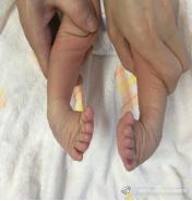 马蹄内翻足孩子的康复,成人马蹄足内翻康复治疗