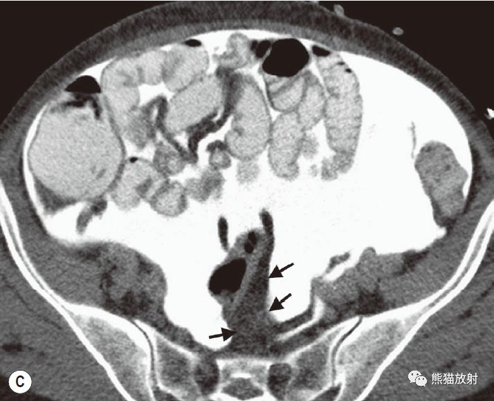 肠系膜解剖图,肠系膜解剖图解