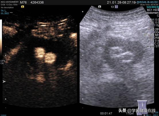 血管外科介入新技术,21世纪血管外科发展方向微创治疗