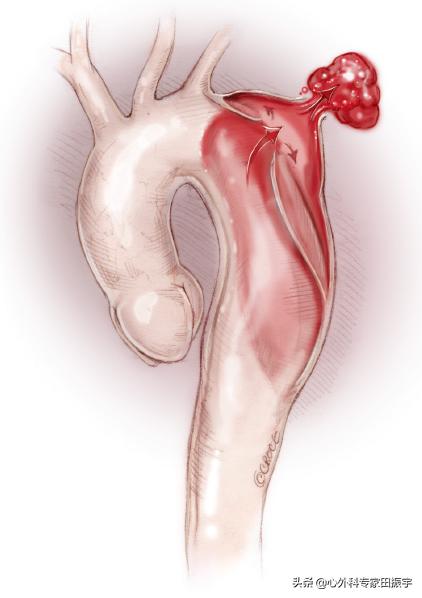 主动脉夹层破裂的院前急救,主动脉夹层破裂的临床表现和处理