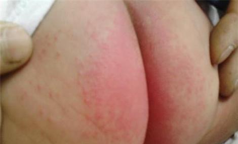 皮肤痒擦炉甘石有用吗,脸红肿痒涂抹炉甘石管用吗