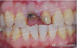 里面的牙如何修复,现在哪里有修复牙齿的