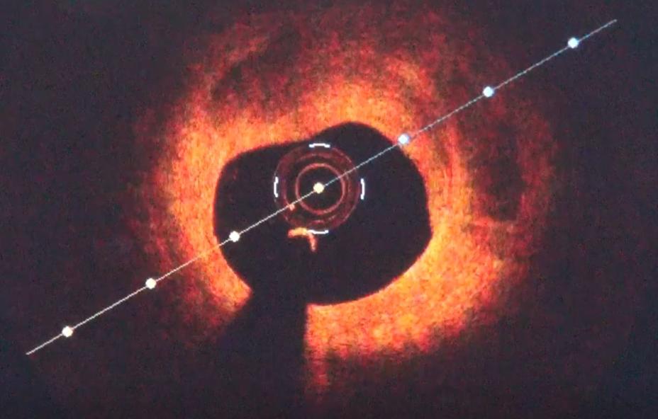 血管狭窄50需要支架吗,血管50%狭窄要长期吃药吗