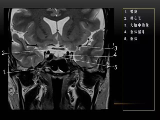 鼻腔鼻窦及颅底ct影像解剖,鼻窦解剖mri