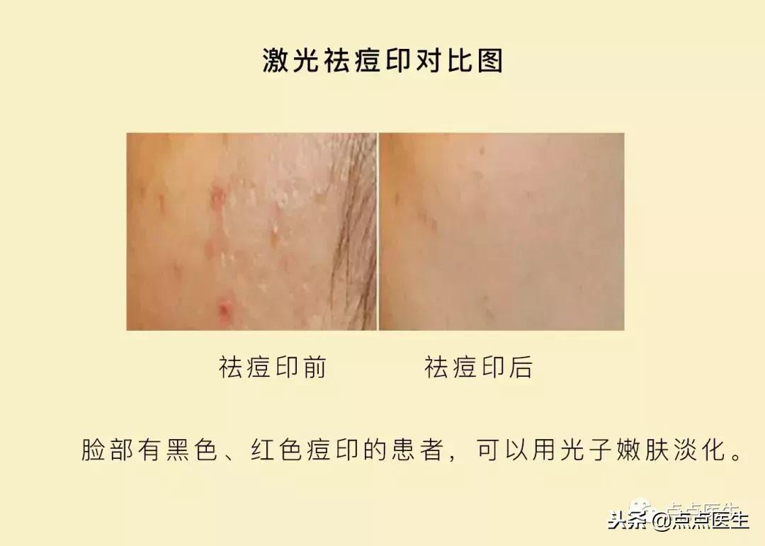 抗衰一定要用医美吗,什么激光抗衰好