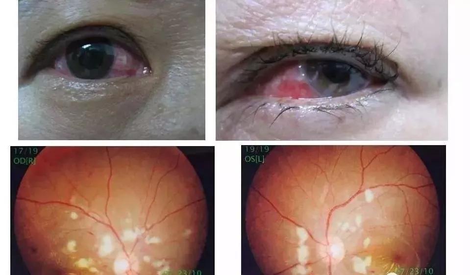 反复口腔溃疡怎么排除白塞病,反复口腔溃疡与白塞病