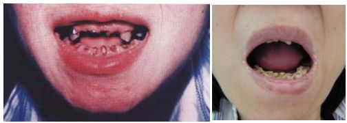 眼干眼涩发痒用什么眼药水,干燥综合征口干眼干吃什么药