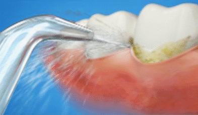 医生我的牙缝很大可以补吗,牙缝很大很深能补吗