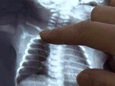 什么是新生儿锁骨骨折？该怎样护理！