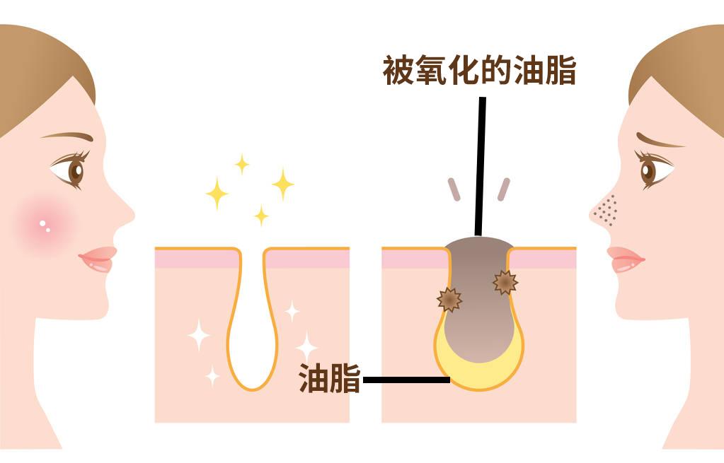 碘伏十滴水去黑头,十滴水碘伏祛黑头正确使用步骤