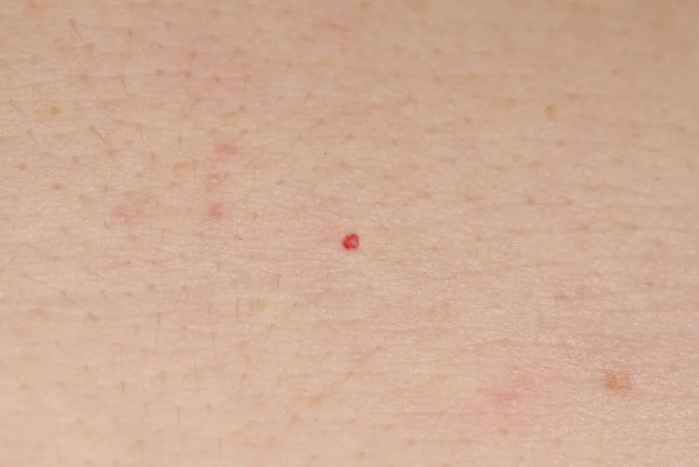 突然全身都长了小红点怎么回事,身上突然有很多小红点是怎么回事