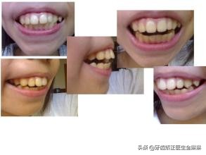 龅牙先天少一颗牙能矫正吗,龅牙可以自己按压恢复吗