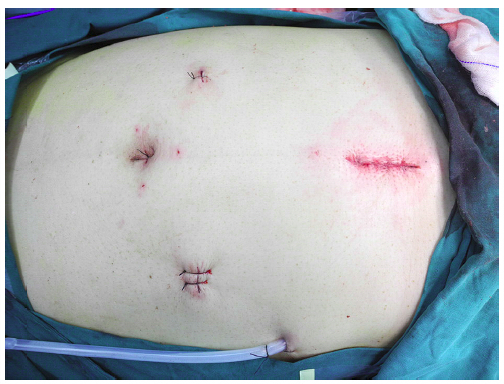 肿瘤切除取出,微创手术切除的肿瘤怎么取出体外