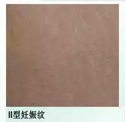 妊娠纹怎么消除才最快最有效,如何快速消除妊娠纹的有效方法