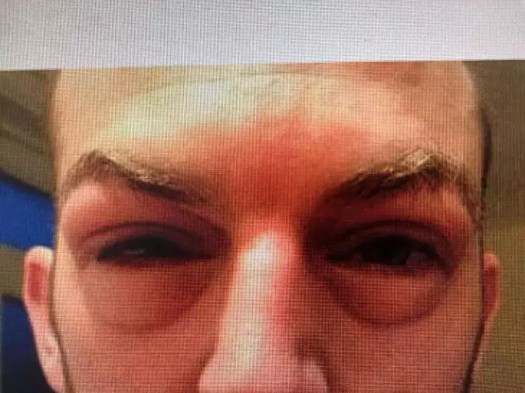 为什么有卧蚕反而不好,天生卧蚕和后天卧蚕有什么区别