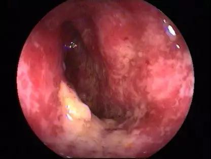 大便表面有粘液是怎么回事,肚子疼大便有粘液怎么回事