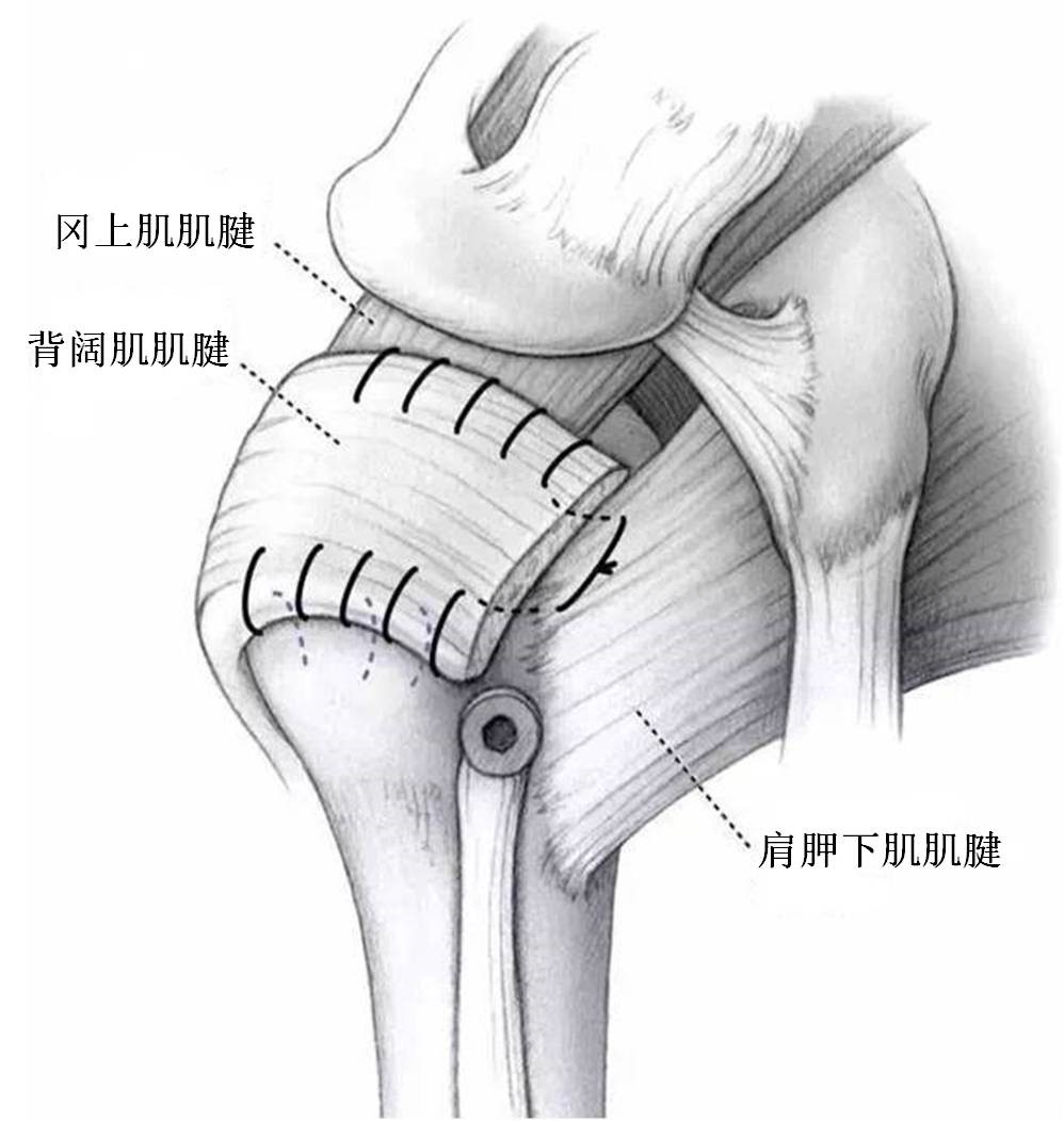 肩袖损伤要怎么处理,肩袖损伤专用膏药