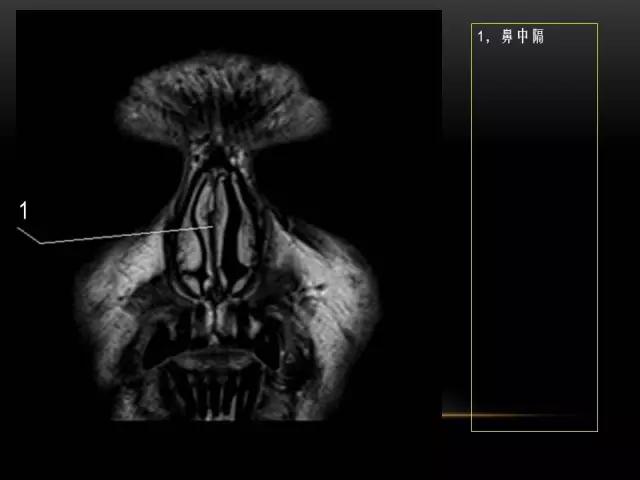 鼻腔鼻窦及颅底ct影像解剖,鼻窦解剖mri