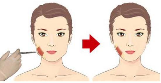 打瘦脸针脸会肿吗,瘦脸针值不值得打