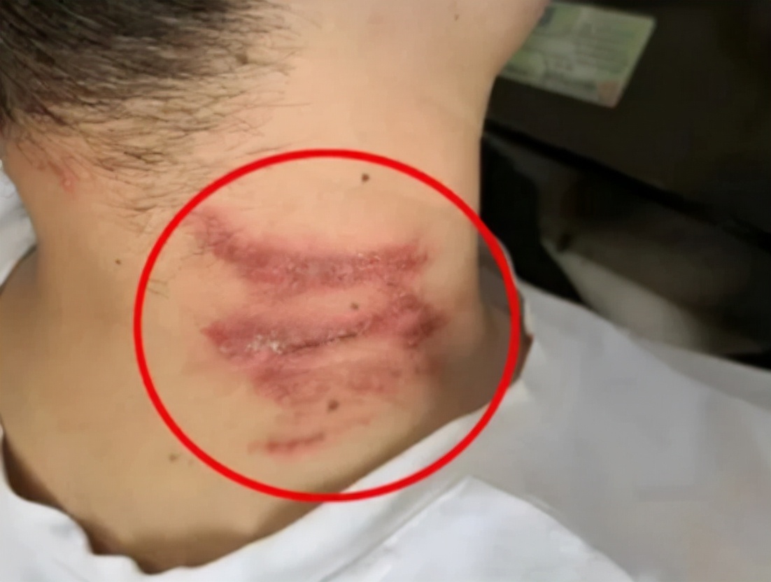 被隐翅虫咬伤有多可怕,被隐翅虫咬后症状图片及治疗方法