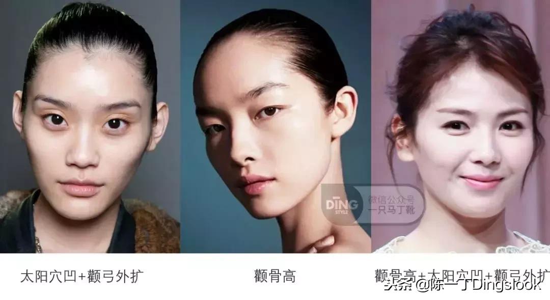 颧骨高太阳穴凹陷怎么改善脸型,颧骨宽大太阳穴凹陷快速改善