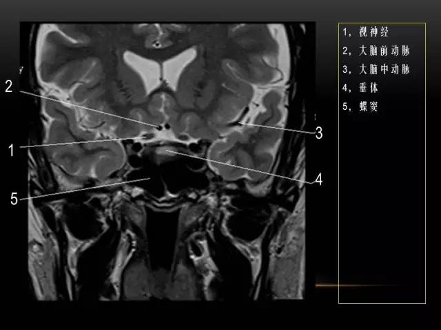 鼻腔鼻窦及颅底ct影像解剖,鼻窦解剖mri