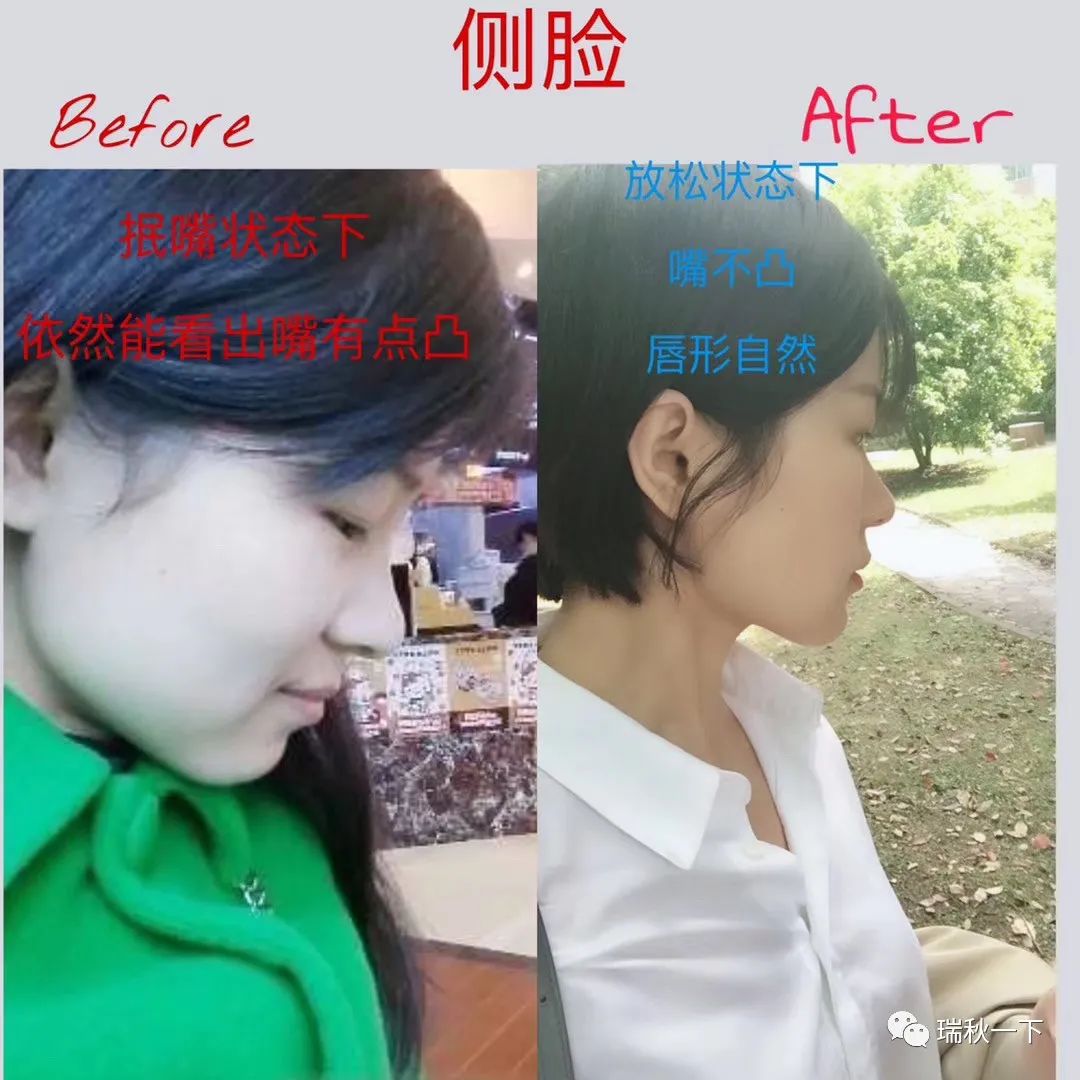 牙齿矫正，你后悔了吗？