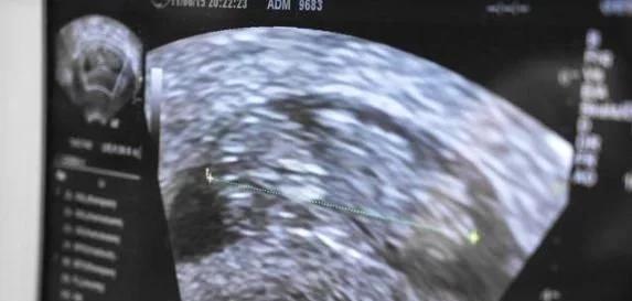 孕期一般做几次b超检查,孕期b超检查不要超过几次