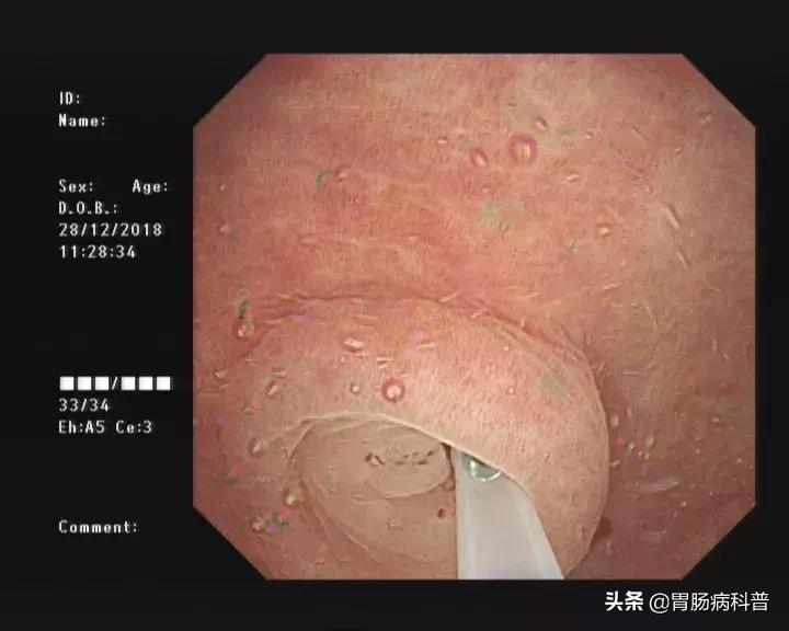 阑尾炎最新内镜微创手术,内镜下阑尾炎治疗术哪里可以做