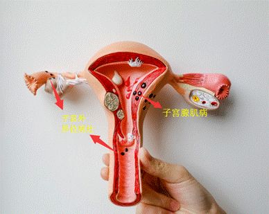 戴曼月乐环后不规则出血怎么办,上曼月乐环后出血和月经分不清