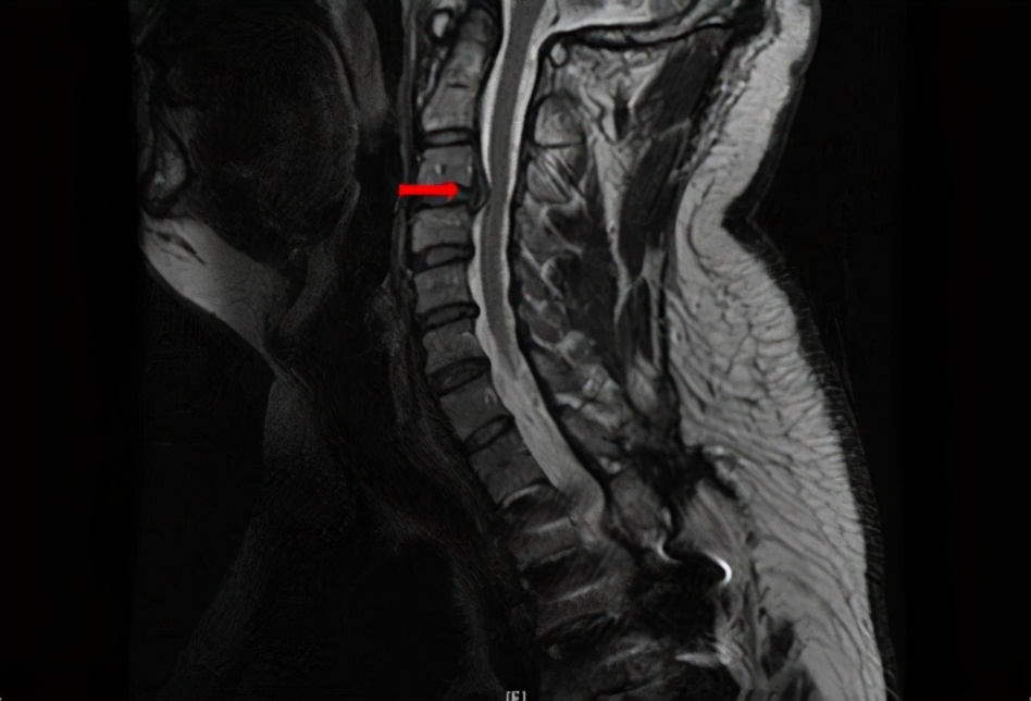 手麻是怎么导致的专家解说,手麻是什么病征兆怎么解决