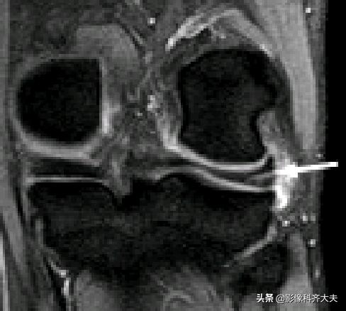 膝关节半月板损伤的磁共振,膝关节半月板病变的mri诊断与鉴别