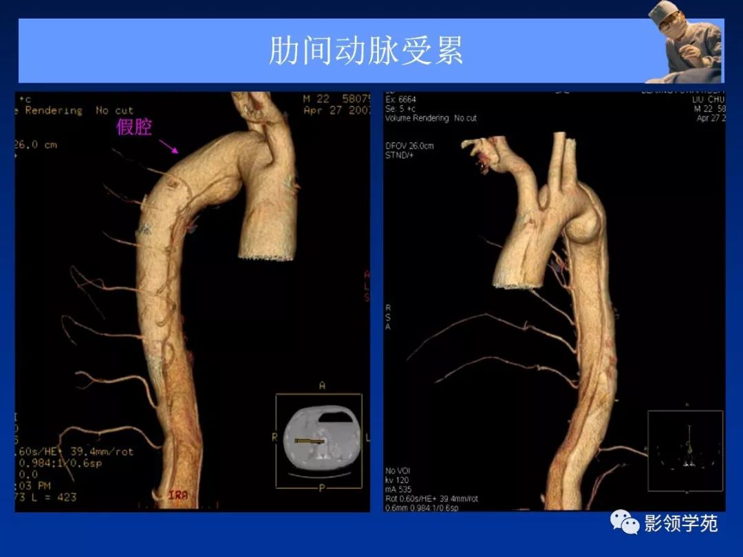 主动脉夹层壁间血肿如何鉴别,主动脉夹层血肿溃疡