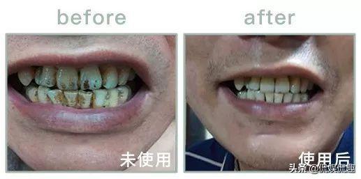 刷牙黄牙变成白牙怎么办,怎么刷牙才会让黄牙变成白牙