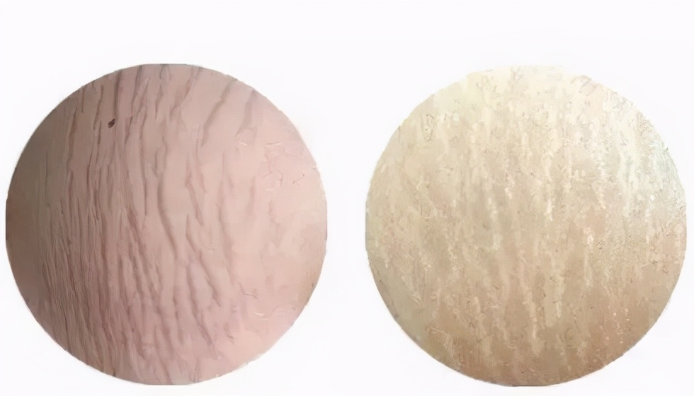 不胖却有生长纹,不胖也会有生长纹