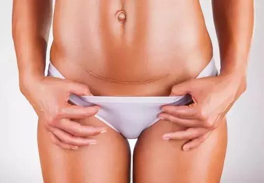 切口妊娠前期注意事项,切口妊娠怎么保胎