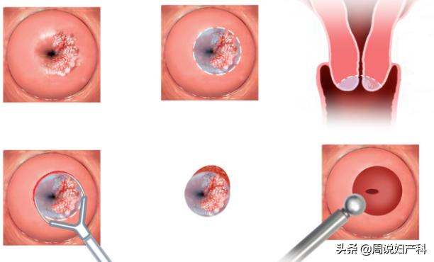 安全套可以有效阻隔hpv病毒吗,安全套能防止hpv吗