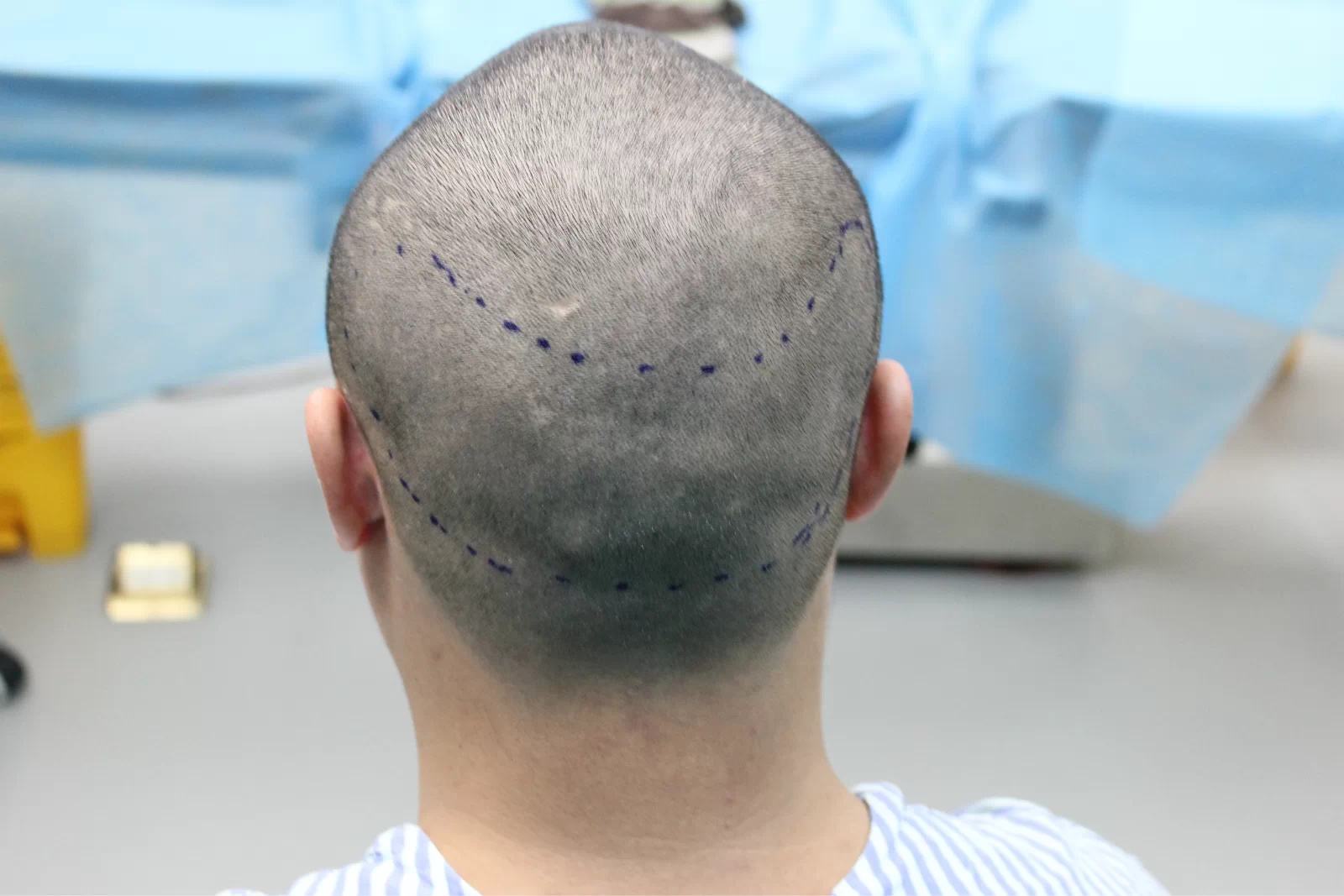 导致脱发真正的原因是什么,常见的引起脱发的原因有哪些