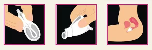 月经杯使用科普,月经杯科普