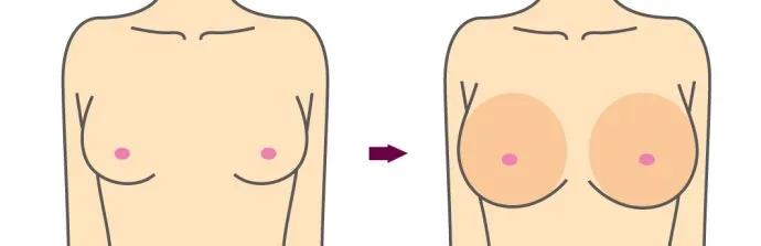 自体脂肪填充全脸逆袭,自体脂肪填充的真相来了