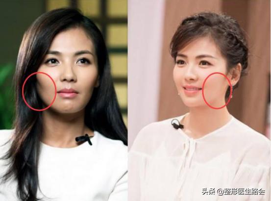 高颧骨苹果肌复位,颧骨太高苹果肌太饱满做什么手术