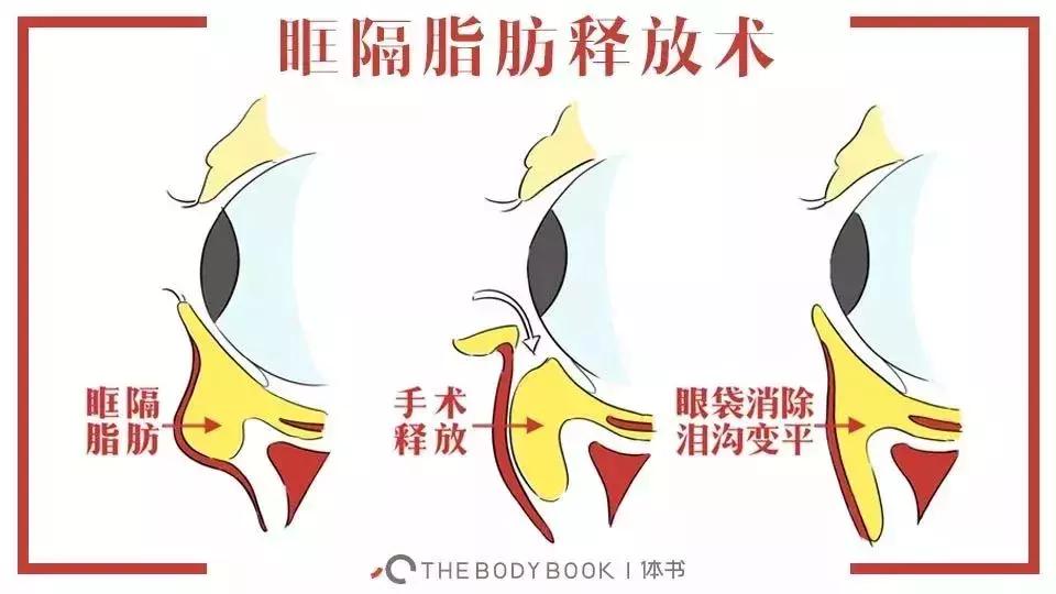 咖啡因淡化什么类型黑眼圈,黑眼圈三种类型你属于哪种